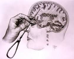 lobotomy